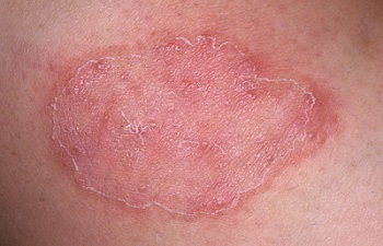 Как вылечить грибок кожи: методы борьбы с причиной и симптомами болезни