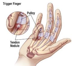 Синдром щелкающего пальца (стенозирующий лигаментит)