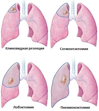 РАК ЛЕГКИХ | Лечение рака легких | Опухоль лёгких | Онкологическая клиника ИННОВАЦИЯ