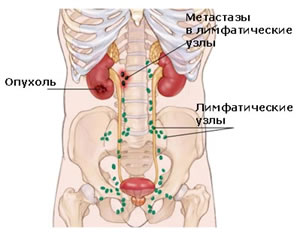 Метастазы в брюшной полости - симптомы, лечение, прогноз.