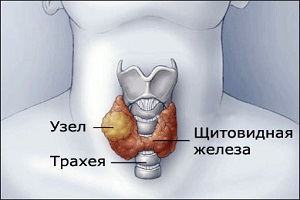 Удаление опухоли щитовидной железы