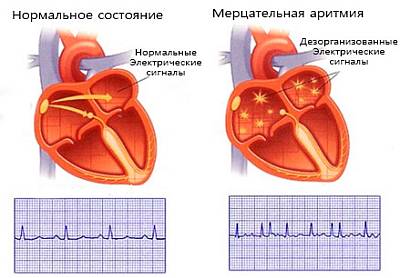 Аритмия сердца — симптомы, причины и лечение